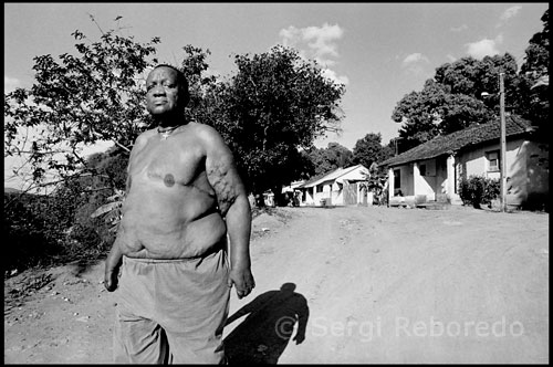 Ubiratan Da Silva Costa. 35 years working as an officer in the former colony of Itaboraí (Rio). She was able to breast surgery. Each one weighed 1.7 kg Brazil, which recorded 38,410 new cases of the disease last year and 30,693 in 2004, has an average of 1.48 cases per 10,000 population.